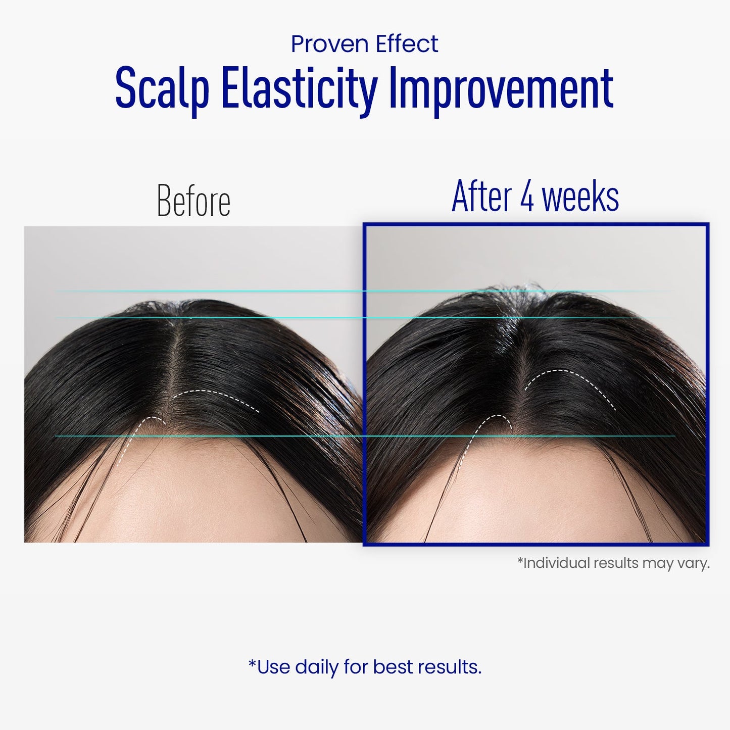 ViveLab Spioxyl™ Scalp Serum 400 – 220K Micro-Spicules for Thicker, Fuller Hair | Korea’s Best-Selling Dermatologist-Recommended K-Beauty Scalp Serum (0.5 fl oz)